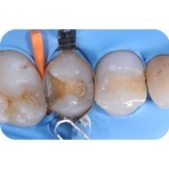 Cuña interdental Odontología