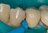 Wedge Wands Cuñas X-Pequeñas Amarillas 100U Garrison Dental