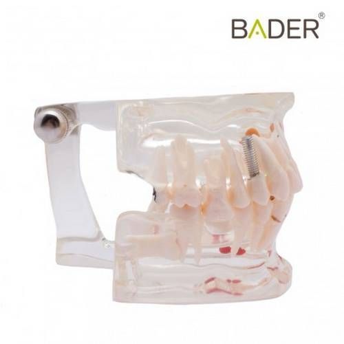 Tipodonto modelo transparente implante Bader
